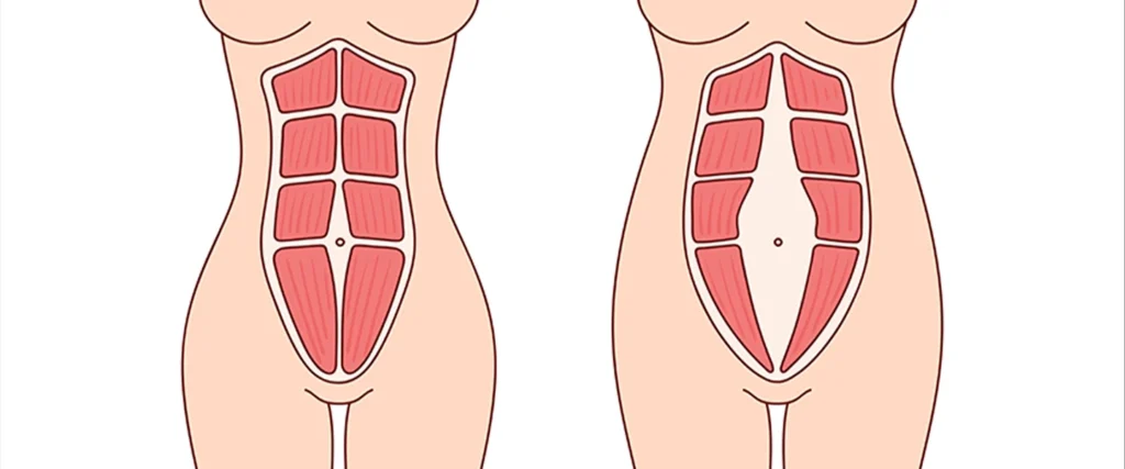 Ilustração de duas mulheres lado a lado, diástase